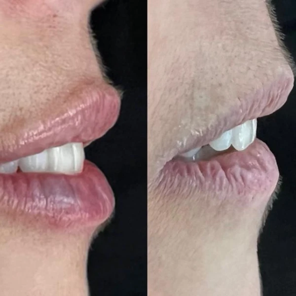 antes-e-depois-bruno-conzi-6